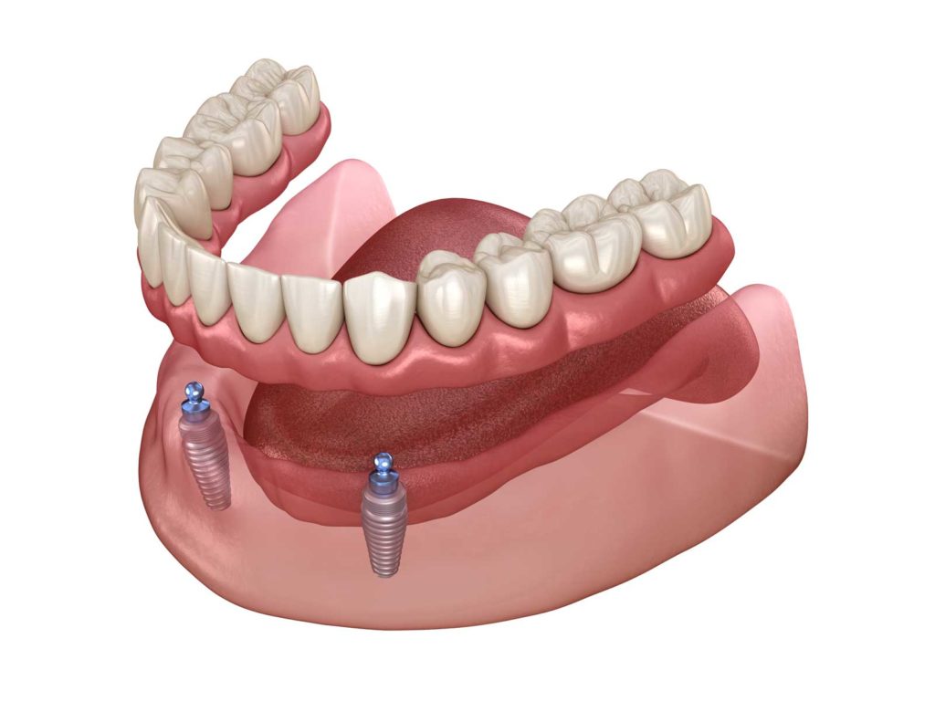 How Dental Implants Secure Your Dentures 6935