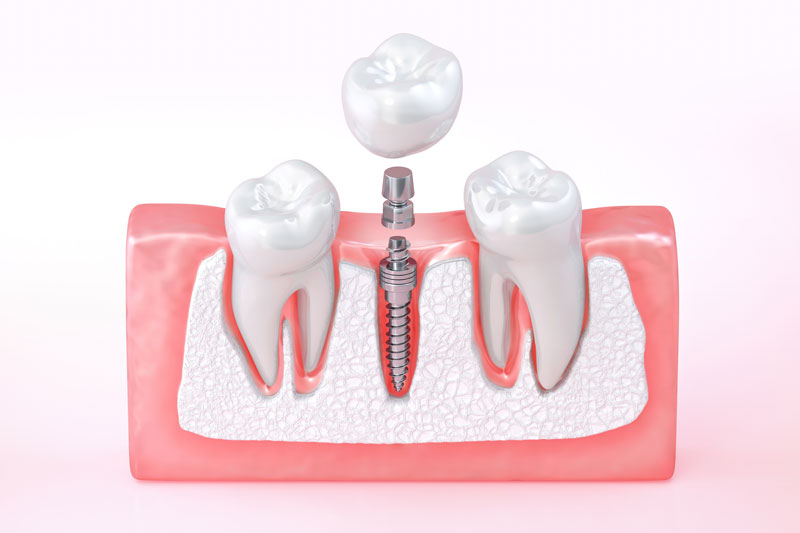 a single dental implant with 2 teeth next to it