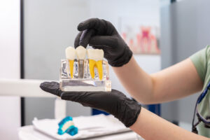 Dental expert holding human teeth model, pointing to the crown of a dental implant, and offering advice on dental implant maintenance and healthy teeth care.