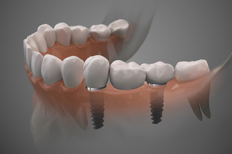 2 single dental implants with a crown on top of each of them