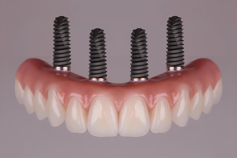 4 dental implants being shown with a full set of teeth attached to the implants