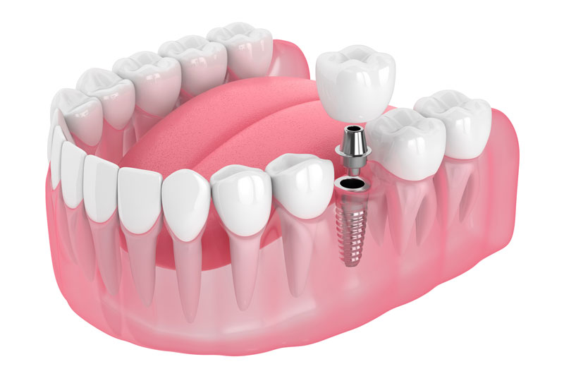 single dental implant with a crown and an abutment floating above the implant